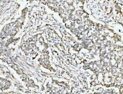 IHC staining of FFPE human lung cancer tissue with RPS6KA4 antibody. HIER: boil tissue sections in pH8 EDTA for 20 min and allow to cool before testing.