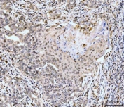 IHC staining of FFPE human metaplasia of squamous cells of the renal pelvis tissue with RPS6KA4 antibody. HIER: boil tissue sections in pH8 EDTA for 20 min and allow to cool before testing.