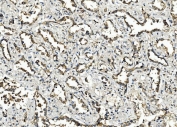 IHC staining of FFPE infiltrating adenocarcinoma of the lung tissue with Zonula occludens protein 2 antibody. HIER: boil tissue sections in pH8 EDTA for 20 min and allow to cool before testing.