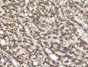 IHC staining of FFPE human liver cancer tissue with Zonula occludens protein 2 antibody. HIER: boil tissue sections in pH8 EDTA for 20 min and allow to cool before testing.