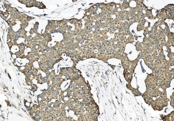 IHC staining of FFPE papillary carcinoma of the left breast tissue with Zonula occludens protein 2 antibody. HIER: boil tissue sections in pH8 EDTA for 20 min and allow to cool before testing.