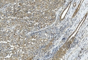 IHC staining of FFPE squamous metaplasia of the renal pelvis tissue with Zonula occludens protein 2 antibody. HIER: boil tissue sections in pH8 EDTA for 20 min and allow to cool before testing.