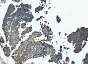 IHC staining of FFPE human bladder cancer tissue with Zonula occludens protein 2 antibody. HIER: boil tissue sections in pH8 EDTA for 20 min and allow to cool before testing.