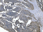 IHC staining of FFPE human ovarian serous adenocarcinoma tissue with Zonula occludens protein 2 antibody. HIER: boil tissue sections in pH8 EDTA for 20 min and allow to cool before testing.