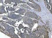 IHC staining of FFPE human ovarian serous adenocarcinoma tissue with Zonula occludens protein 2 antibody. HIER: boil tissue sections in pH8 EDTA for 20 min and allow to cool before testing.