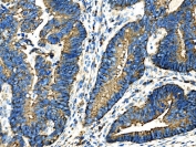 IHC staining of FFPE differentiated adenocarcinoma of the rectum tissue with Zonula occludens protein 2 antibody. HIER: boil tissue sections in pH8 EDTA for 20 min and allow to cool before testing.