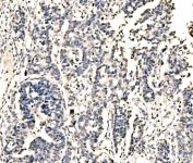 IHC staining of FFPE human bladder epithelial carcinoma tissue with KIAA1429 antibody. HIER: boil tissue sections in pH8 EDTA for 20 min and allow to cool before testing.