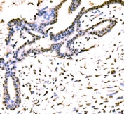 IHC staining of FFPE human breast cancer tissue with KIAA1429 antibody. HIER: boil tissue sections in pH8 EDTA for 20 min and allow to cool before testing.