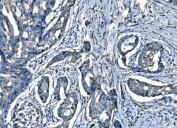 IHC staining of FFPE adenocarcinoma of the colon with Atlastin-1 antibody. HIER: boil tissue sections in pH8 EDTA for 20 min and allow to cool before testing.