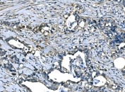 IHC staining of FFPE human stomach cancer tissue with Atlastin-1 antibody. HIER: boil tissue sections in pH8 EDTA for 20 min and allow to cool before testing.