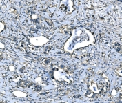 IHC staining of FFPE human cervical cancer with Atlastin-1 antibody. HIER: boil tissue sections in pH8 EDTA for 20 min and allow to cool before testing.