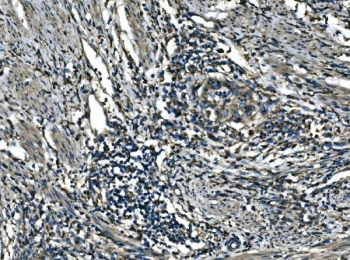 IHC staining of FFPE human cervical cancer tissue with ATP6V1A antibody. HIER: boil tissue sections in pH8 EDTA for 20 min and allow to cool before testing.