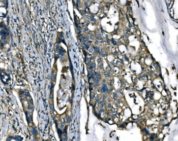 IHC staining of FFPE adenocarcinoma of the colon with ATP6V1A antibody. HIER: boil tissue sections in pH8 EDTA for 20 min and allow to cool before testing.