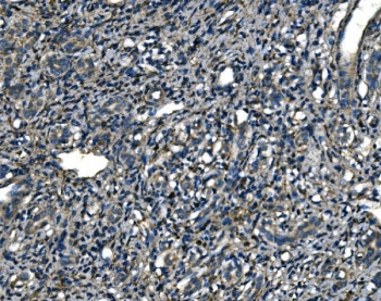 IHC staining of FFPE human liver cancer tissue with ATP6V1A antibody. HIER: boil tissue sections in pH8 EDTA for 20 min and allow to cool before testing.