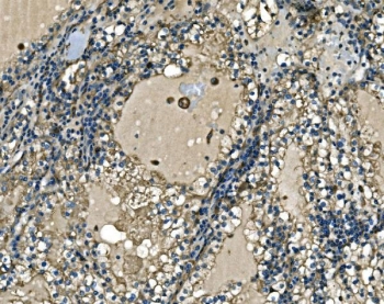 IHC staining of FFPE human renal cell carcinoma tissue with ATP6V1A antibody. HIER: boil tissue sections in pH8 EDTA for 20 min and allow to cool before testing.