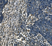 IHC staining of FFPE human lung cancer tissue with ATP6V1A antibody. HIER: boil tissue sections in pH8 EDTA for 20 min and allow to cool before testing.