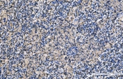 IHC staining of FFPE human lung cancer tissue with CD9 antibody. HIER: boil tissue sections in pH8 EDTA for 20 min and allow to cool before testing.