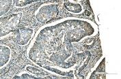 IHC staining of FFPE adenocarcinoma of the right colon with CD9 antibody. HIER: boil tissue sections in pH8 EDTA for 20 min and allow to cool before testing.