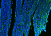 Immunofluorescent staining of FFPE human intestinal cancer tissue with CD9 antibody (green) and DAPI nuclear stain (blue). HIER: steam section in pH6 citrate buffer for 20 min.