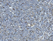 IHC staining of FFPE human lymphadenoma tissue with CD14 antibody. HIER: boil tissue sections in pH8 EDTA for 20 min and allow to cool before testing.