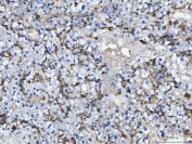 IHC staining of FFPE human renal cell carcinoma tissue with CD14 antibody. HIER: boil tissue sections in pH8 EDTA for 20 min and allow to cool before testing.