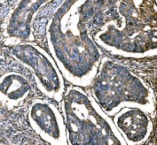 IHC staining of FFPE human colon adenocarcinoma tissue with CD276 antibody. HIER: boil tissue sections in pH8 EDTA for 20 min and allow to cool before testing.