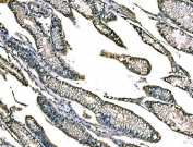 IHC staining of FFPE human gastric cancer tissue with Claudin 18 antibody. HIER: boil tissue sections in pH8 EDTA for 20 min and allow to cool before testing.