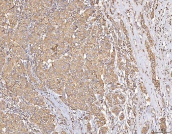 IHC staining of FFPE human breast cancer tissue with Calmegin antibody. HIER: boil tissue sections in pH8 EDTA for 20 min and allow to cool before testing.