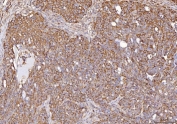 IHC staining of FFPE human ovarian cancer tissue with Calmegin antibody. HIER: boil tissue sections in pH8 EDTA for 20 min and allow to cool before testing.