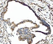 IHC staining of FFPE human cervical cancer tissue with CPT1-L antibody. HIER: boil tissue sections in pH8 EDTA for 20 min and allow to cool before testing.