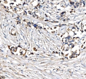 IHC staining of FFPE human breast cancer tissue with CPT1-L antibody. HIER: boil tissue sections in pH8 EDTA for 20 min and allow to cool before testing.