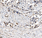 IHC staining of FFPE human breast cancer tissue with CPT1-L antibody. HIER: boil tissue sections in pH8 EDTA for 20 min and allow to cool before testing.