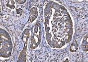 IHC staining of FFPE human adenocarcinoma of the right colon tissue with CPT1-L antibody. HIER: boil tissue sections in pH8 EDTA for 20 min and allow to cool before testing.