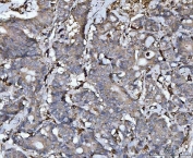 IHC staining of FFPE human rectal cancer tissue with CTSB antibody. HIER: boil tissue sections in pH8 EDTA for 20 min and allow to cool before testing.