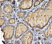 IHC staining of FFPE human thyroid cancer tissue with CTSB antibody. HIER: boil tissue sections in pH8 EDTA for 20 min and allow to cool before testing.