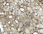 IHC staining of FFPE human liver cancer tissue with CTSB antibody. HIER: boil tissue sections in pH8 EDTA for 20 min and allow to cool before testing.