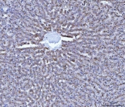 IHC staining of FFPE rat liver cancer tissue with CTSB antibody. HIER: boil tissue sections in pH8 EDTA for 20 min and allow to cool before testing.