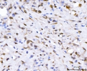 IHC staining of FFPE human gastric cancer tissue with Fibroblast Growth Factor 2 antibody. HIER: boil tissue sections in pH8 EDTA for 20 min and allow to cool before testing.