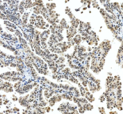 IHC staining of FFPE human ovarian cancer tissue with FOXL2 antibody, HRP-secondary and DAB substrate. HIER: boil tissue sections in pH8 EDTA for 20 min and allow to cool before testing.