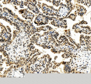 IHC staining of FFPE human lung cancer tissue with FOXL2 antibody, HRP-secondary and DAB substrate. HIER: boil tissue sections in pH8 EDTA for 20 min and allow to cool before testing.