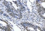 IHC staining of FFPE human rectal cancer tissue with TLS antibody. HIER: boil tissue sections in pH8 EDTA for 20 min and allow to cool before testing.