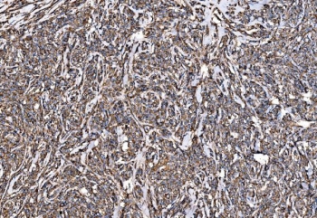IHC staining of FFPE human lymphoma tissue with G3BP1 antibody. HIER: boil tissue sections in pH8 EDTA for 20 min and allow to cool before testing.