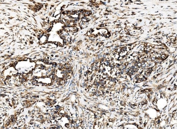 IHC staining of FFPE human stomach cancer tissue with G3BP1 antibody. HIER: boil tissue sections in pH8 EDTA for 20 min and allow to cool before testing.