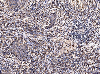 IHC staining of FFPE human lung cancer tissue with G3BP1 antibody. HIER: boil tissue sections in pH8 EDTA for 20 min and allow to cool before testing.