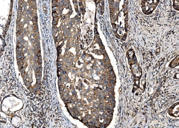 IHC staining of FFPE human adenocarcinoma of the right colon with G3BP1 antibody. HIER: boil tissue sections in pH8 EDTA for 20 min and allow to cool before testing.