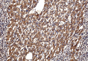 IHC staining of FFPE human liver cancer with G3BP1 antibody. HIER: boil tissue sections in pH8 EDTA for 20 min and allow to cool before testing.