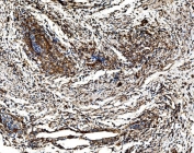 IHC staining of FFPE human cervical cancer tissue with G3BP1 antibody. HIER: boil tissue sections in pH8 EDTA for 20 min and allow to cool before testing.