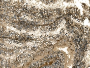 IHC staining of FFPE human renal cell carcinoma with G3BP1 antibody. HIER: boil tissue sections in pH8 EDTA for 20 min and allow to cool before testing.