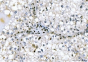IHC staining of FFPE human renal cell carcinoma tissue with GADD45B antibody. HIER: boil tissue sections in pH8 EDTA for 20 min and allow to cool before testing.