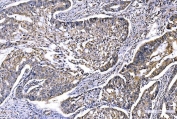 IHC staining of FFPE human colon adenocarcinoma tissue with GFPT1 antibody. HIER: boil tissue sections in pH8 EDTA for 20 min and allow to cool before testing.
